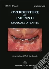 Reso Gratuito Overdenture su impianti. Manuale atlante